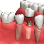 Dental İmplant